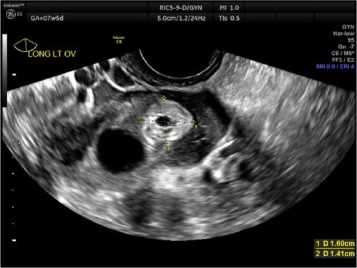 Hesi case study ectopic pregnancy